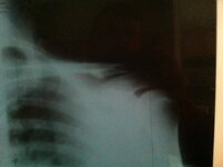 shoulder x-ray.jpg